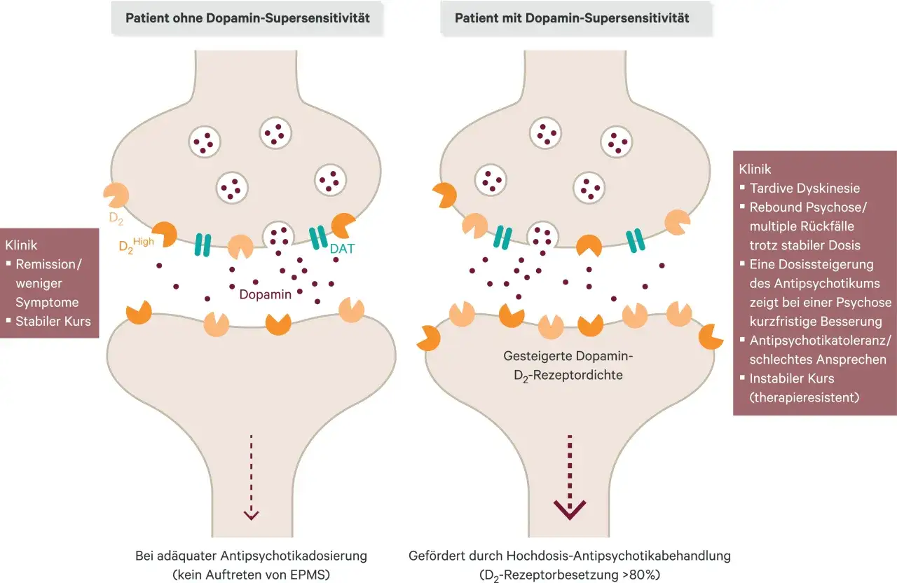 Synapse bei Dopamin-Supersensitivität. Haloperidol kann hier zu Nebenwirkungen wie Tardiver Dyskinesie führen.