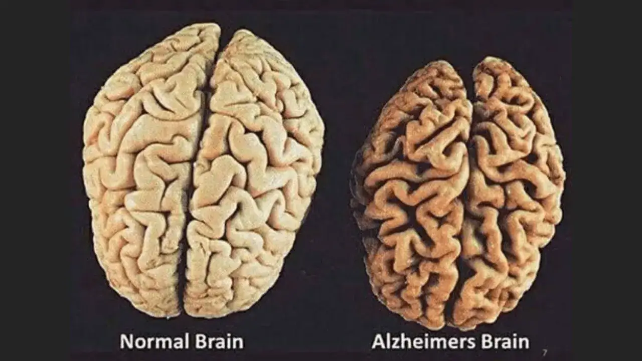 Mózg zdrowy a mózg z chorobą Alzheimera porównanie
