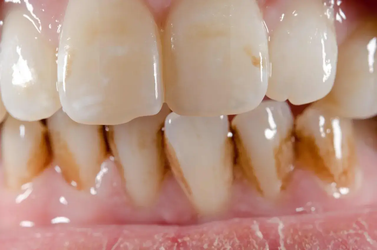 Primer plano de dientes con manchas marrones en las muelas que no son caries, indicando posible acumulaci&oacute;n de sarro o pigmentaci&oacute;n.