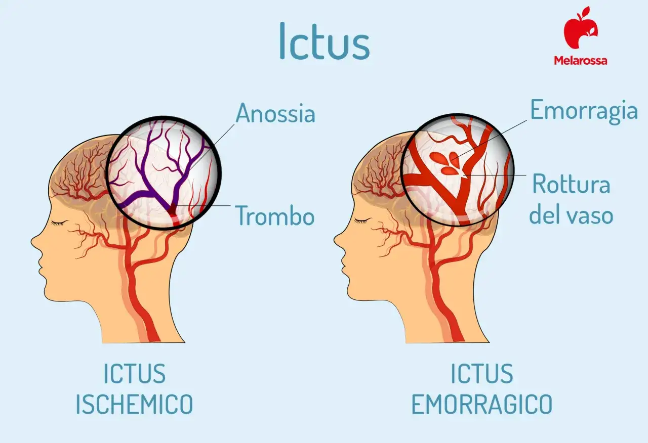 Ictus ischemico con trombo e anossia, ictus emorragico con rottura del vaso. Valutazione punteggio invalidità per ischemia cerebrale.