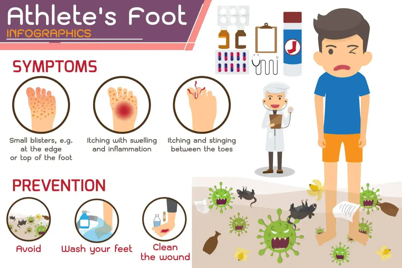 Infografía sobre tipos hongos en los pies: síntomas como ampollas, picazón e inflamación, y prevención.