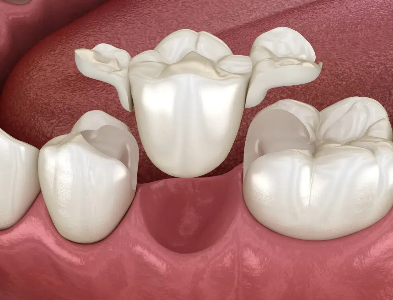 Nowy, piękny most porcelanowy na podbudowie metalowej, gotowy do osadzenia na zębach.