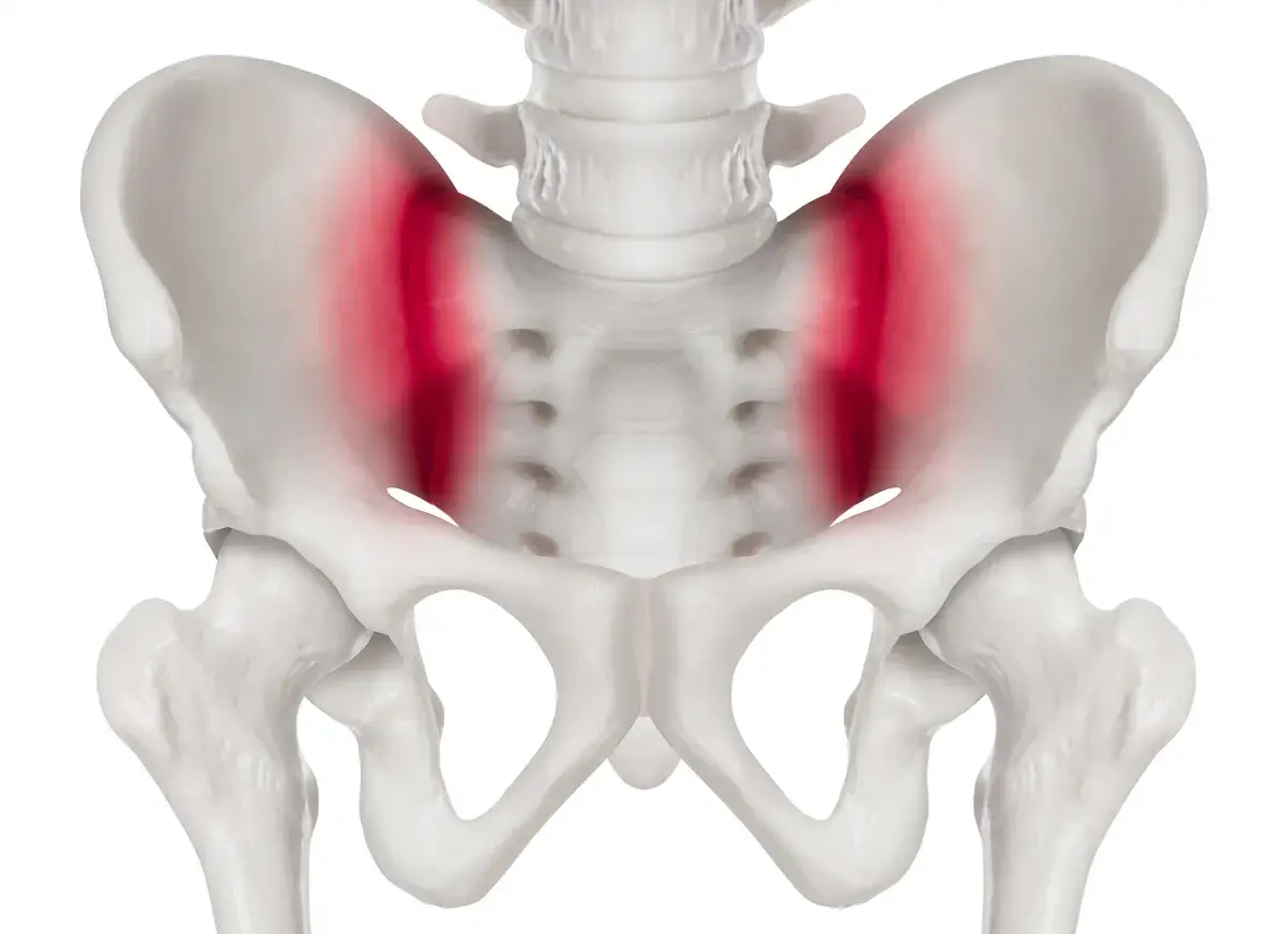 Beckenknochen mit rot hervorgehobenen Bereichen, die auf ISG Arthrose hinweisen.