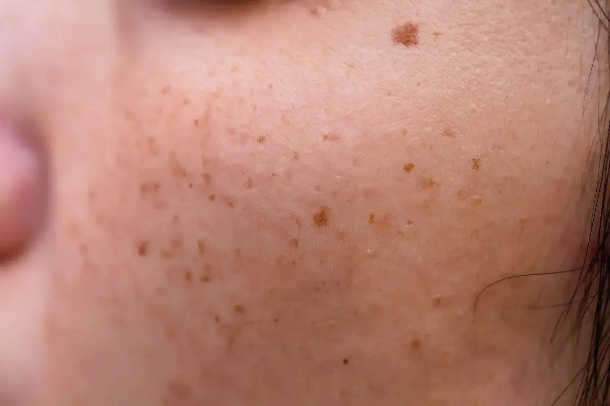 Primo piano del viso con numerose macchie di sole e un neo più scuro. La pelle è chiara e leggermente rosata.