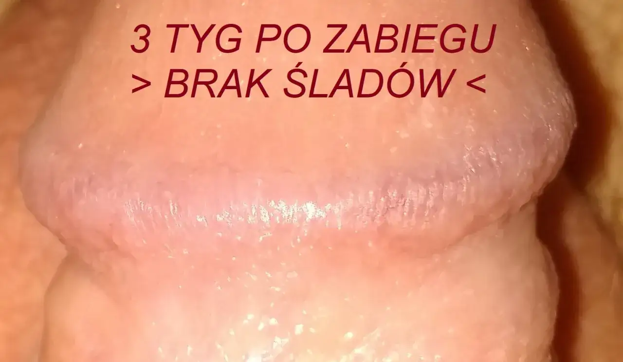 Przedstawia prącie po zabiegu, gdzie widoczne są nieinfekcyjne zmiany. Po 3 tygodniach brak śladów.