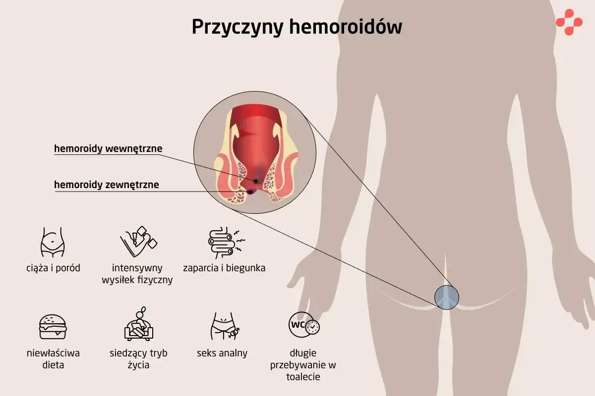 Ilustracja przedstawia przyczyny hemoroidów, w tym wypadanie odbytu, ciąża, wysiłek fizyczny, zaparcia, dieta, siedzący tryb życia i seks analny.