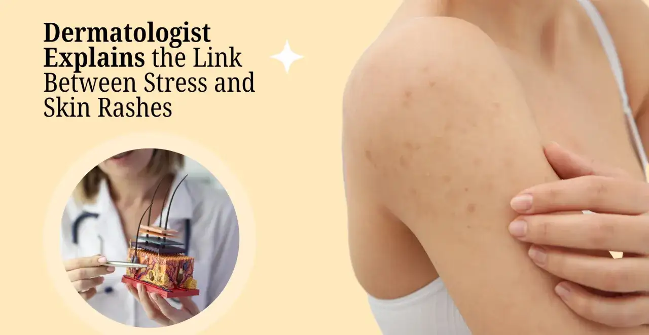 Dermatolog förklarar kopplingen mellan stress och hudutslag. En person med utslag på armen, som kan orsaka stress klåda.