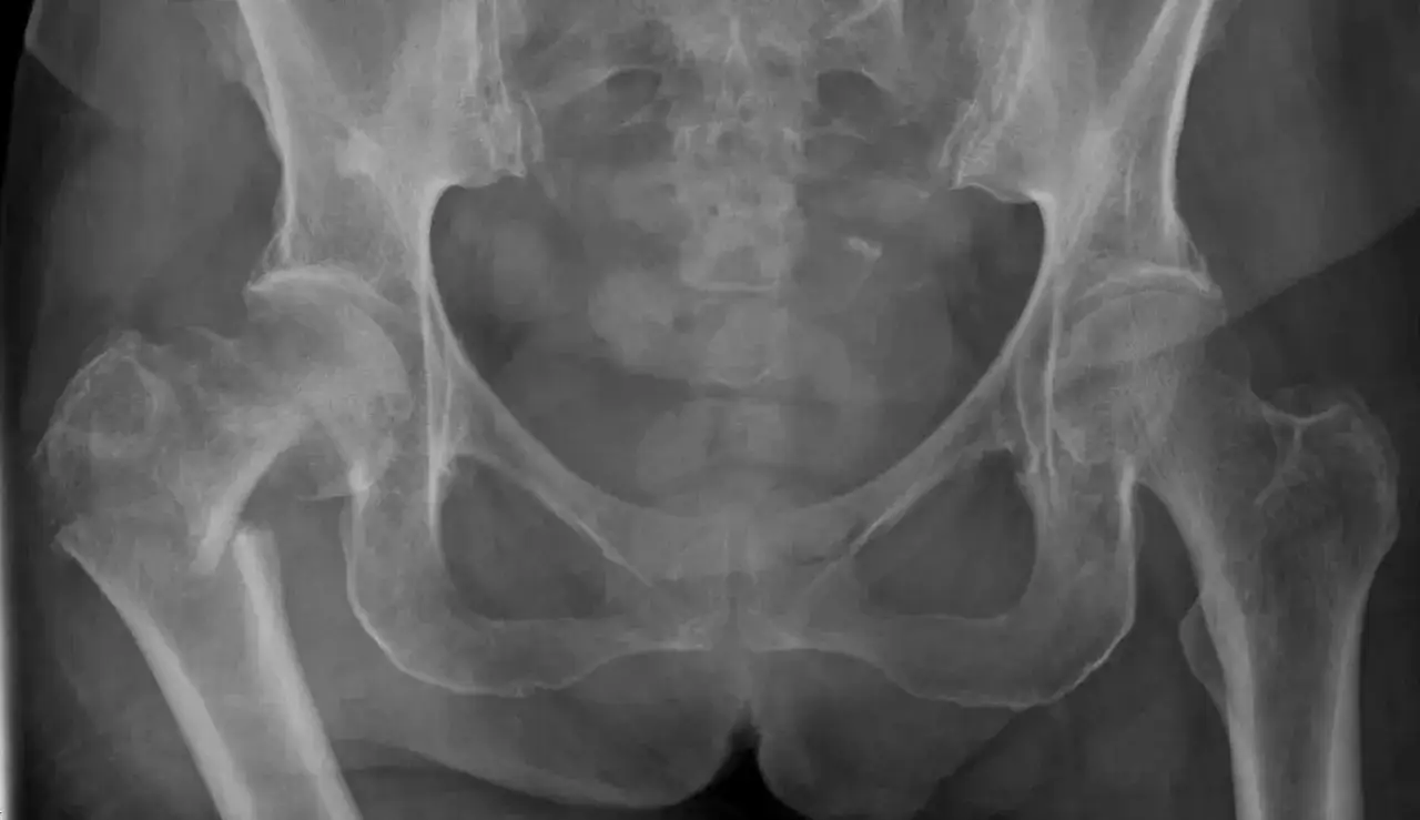 Radiografia del bacino e delle anche che mostra segni di metastasi ossee, con alterazioni strutturali e possibili fratture.