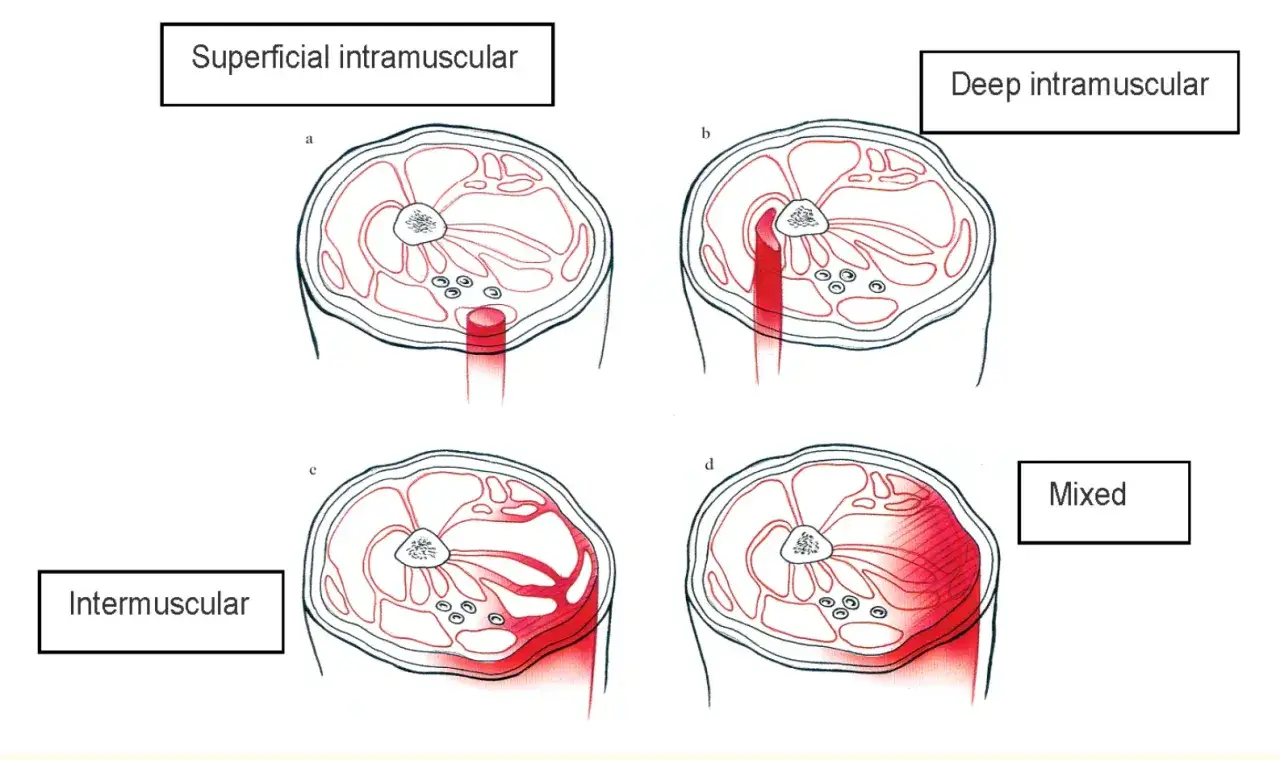 Illustrations montrant un claquage mollet avec hématome, superficiel, profond, intermusculaire et mixte.