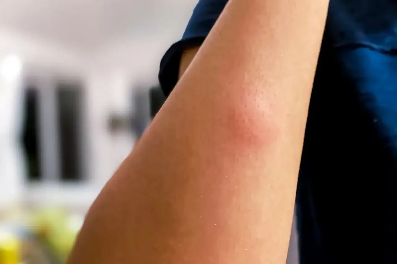 Un bras avec un bouton de moustique rouge et enflé.