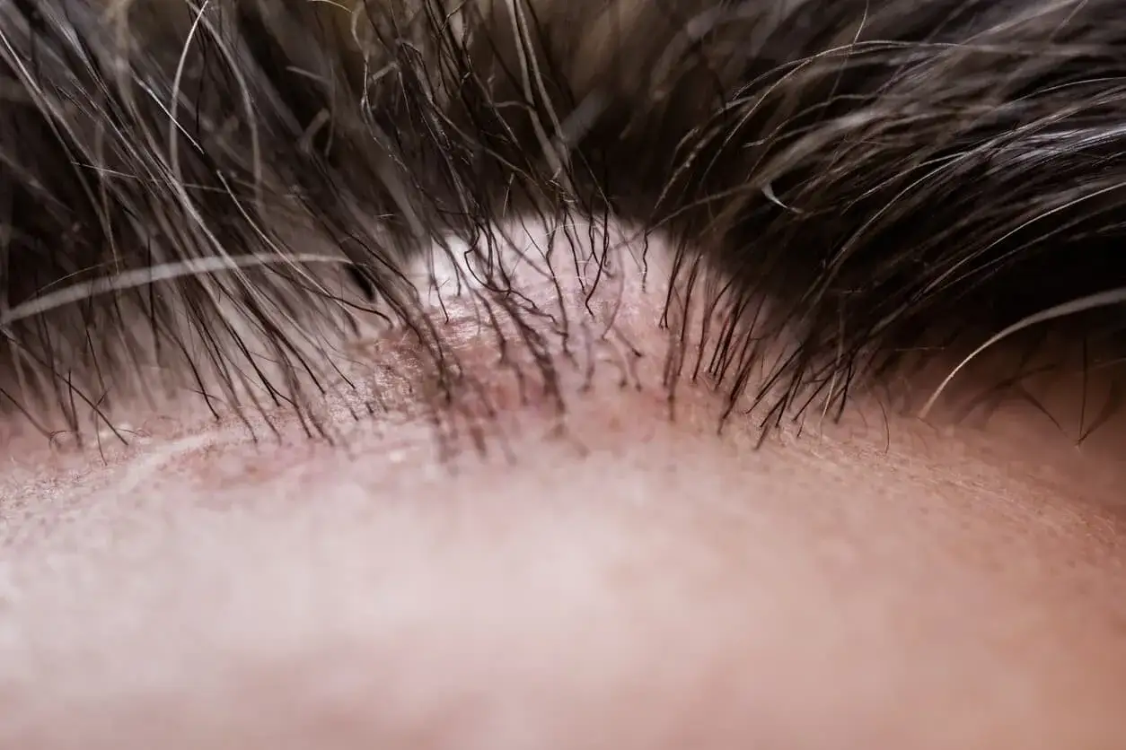 Primo piano della pelle con capelli scuri e una protuberanza sulla fronte, leggermente arrossata e con piccole scaglie.