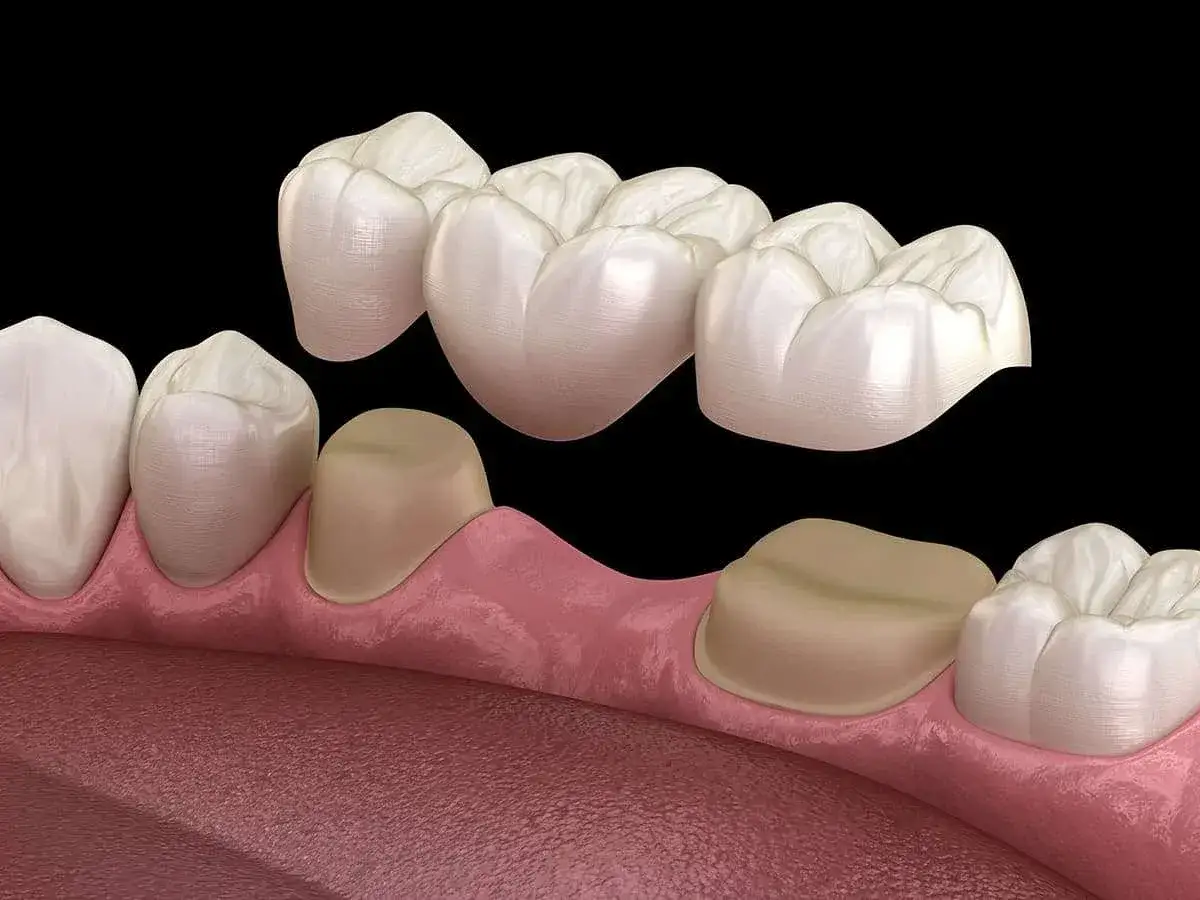 Un ponte dentale che sostituisce un dente mancante, ancorato a corone su denti adiacenti.