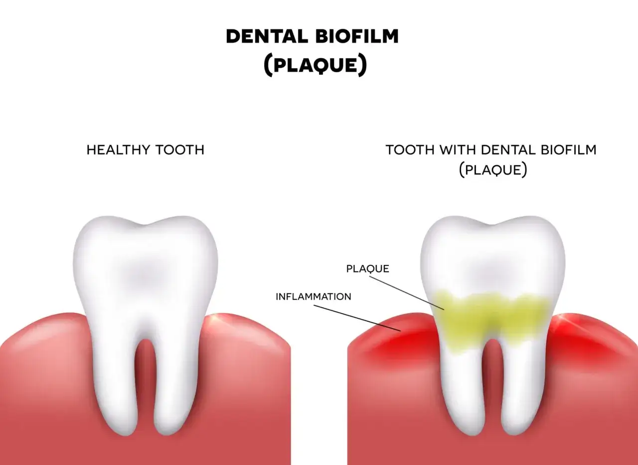 Confronto tra dente sano e dente con placca, che causa infiammazione e la temuta puzza tra i denti.