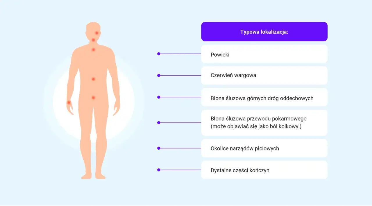 Ilustracja pokazuje typowe lokalizacje obrzęku naczynioruchowego: powieki, usta, drogi oddechowe, przewód pokarmowy, narządy płciowe i kończyny.