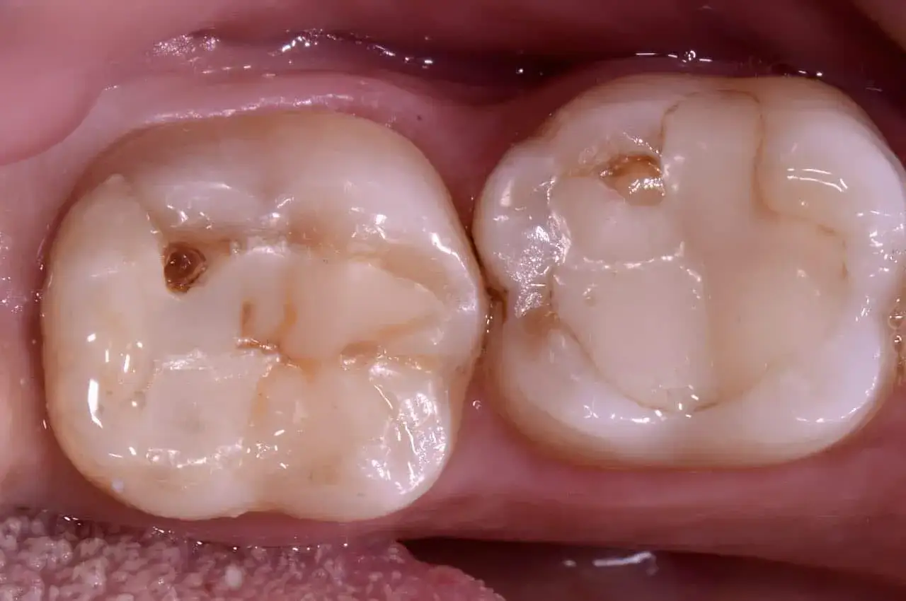 Denti con carie visibili. La cura tempestiva è fondamentale per sapere quanto tempo ci vuole per curare una carie.