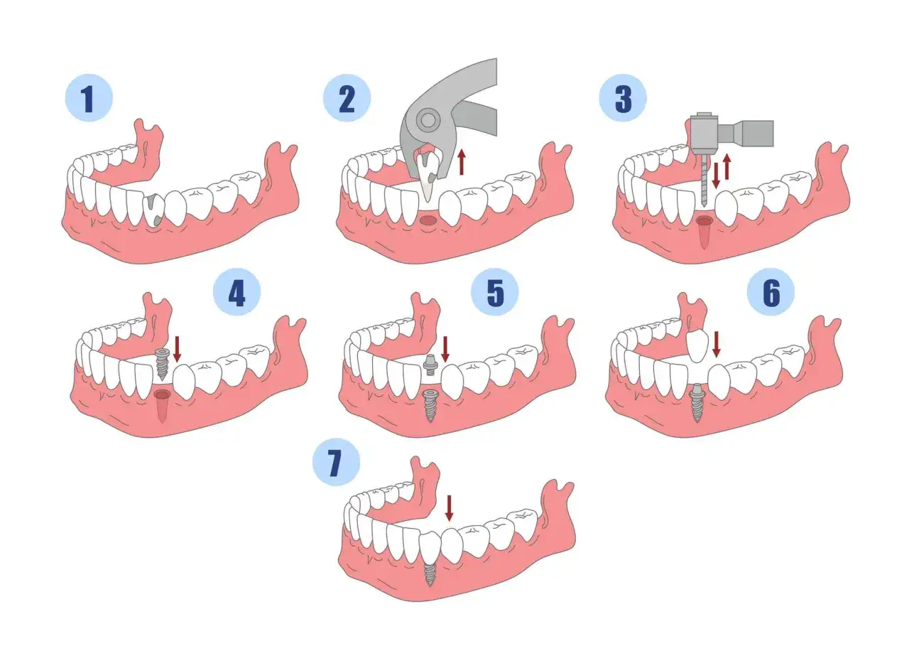 Ilustracja pokazuje etapy wszczepienia implantu stomatologicznego: ekstrakcja zęba, przygotowanie miejsca, wszczepienie implantu, a następnie umieszczenie korony.