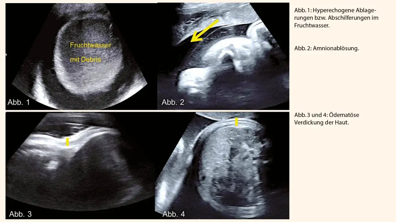 Ultraschallbilder zeigen zu viel Fruchtwasser mit Ablagerungen (Abb. 1), Amnionabl&ouml;sung (Abb. 2) und verdickte Haut (Abb. 3, 4).