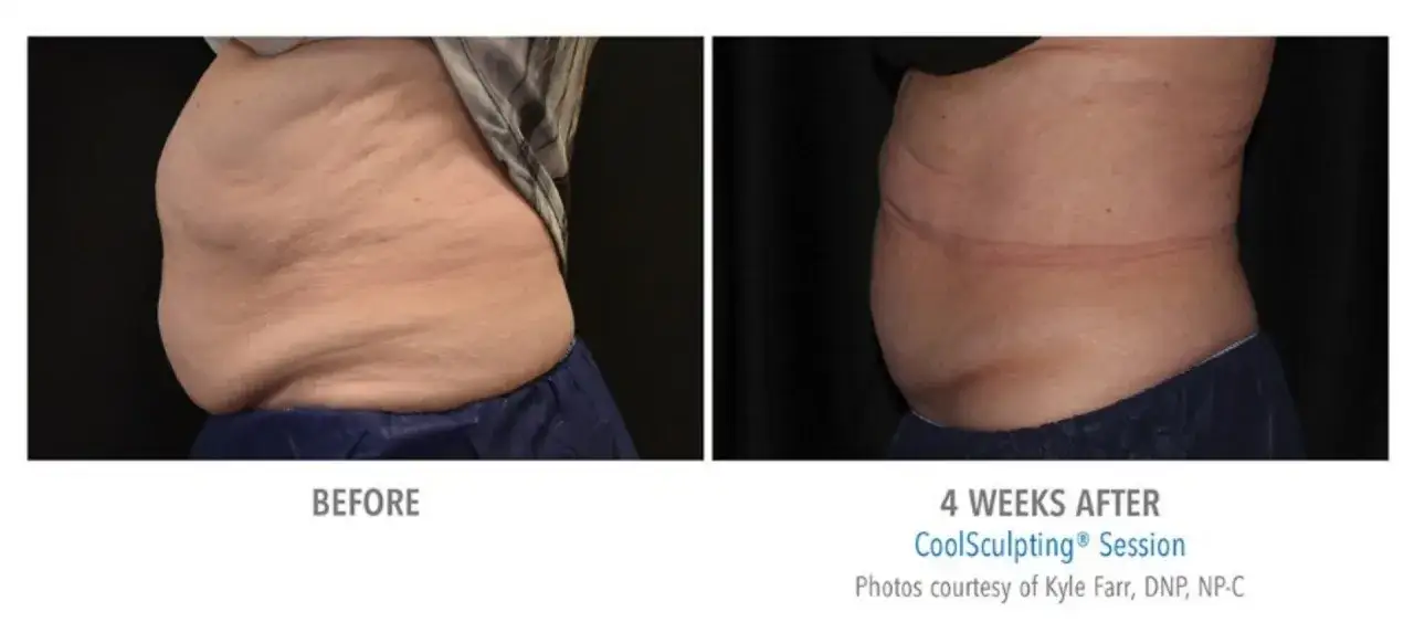 Przed i po zabiegu CoolSculpting. Widoczne znaczące kriolipoliza efekty w redukcji tkanki tłuszczowej na brzuchu po 4 tygodniach.