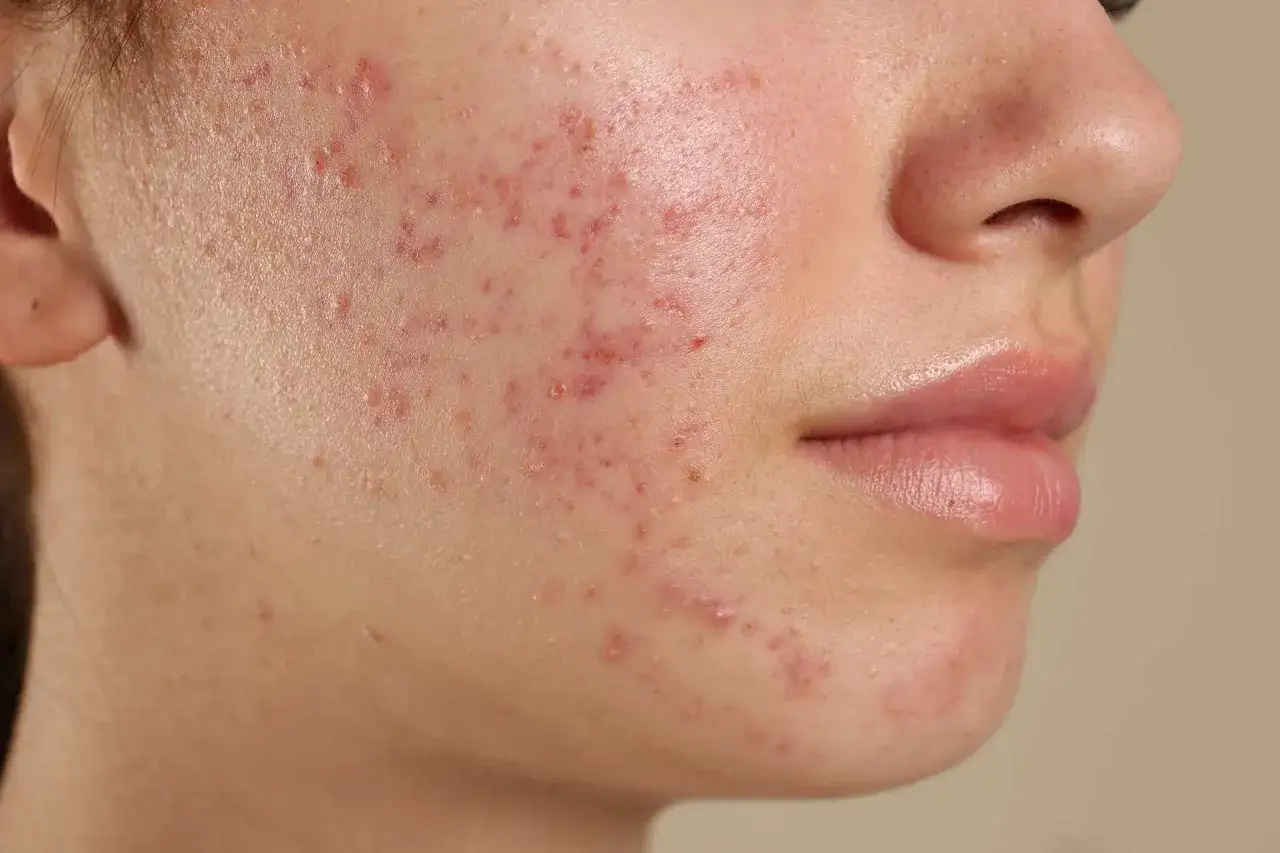 Gros plan sur le visage d'une jeune personne montrant des rougeurs et des imperfections typiques de l'acn&eacute; adolescent.