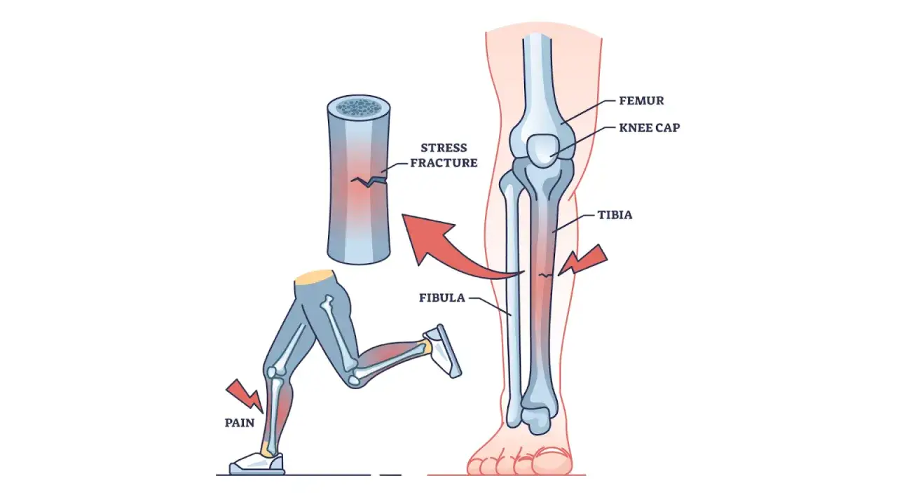 Sch&eacute;ma illustrant la douleur au tibia chez un coureur d&eacute;butant, montrant une fracture de fatigue.