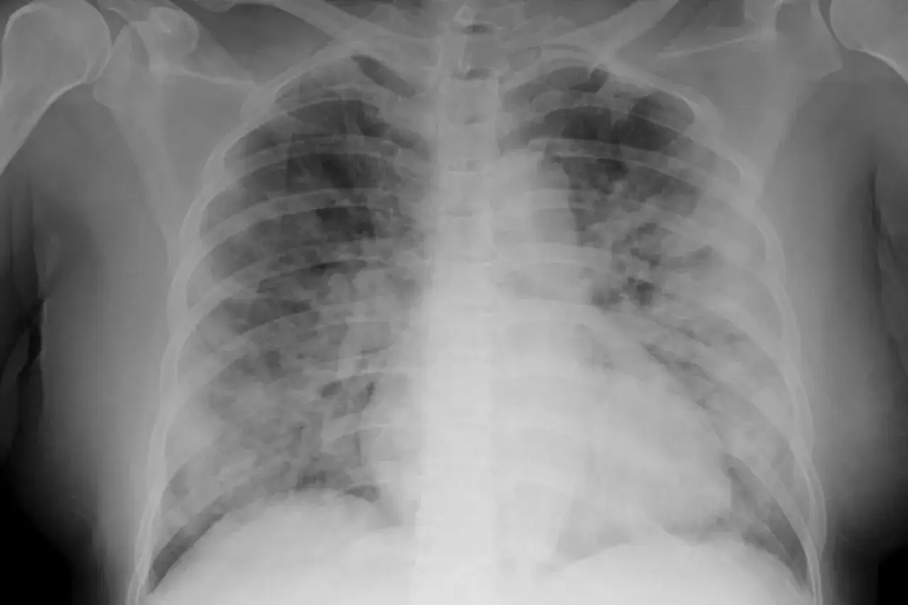 Radiographie pulmonaire montrant une infection pulmonaire avec des opacités diffuses, nécessitant un traitement rapide.