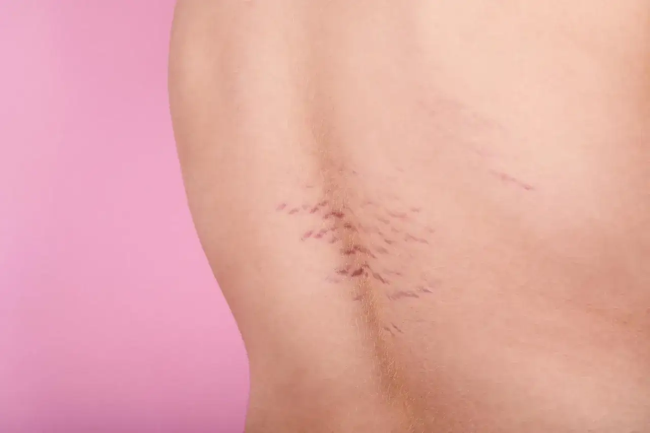 Pelle chiara con smagliature viola che si estendono come rami su uno sfondo rosa.