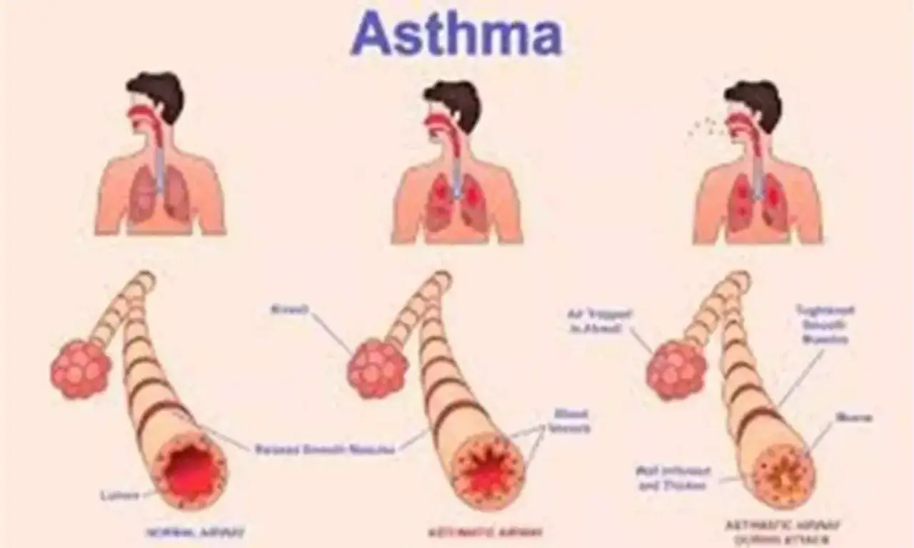Illustration zeigt, wie Bronchien krampfen bei Asthma. Ein normaler Atemweg wird mit einem asthmatischen verglichen, bei dem die Muskeln sich verengen.