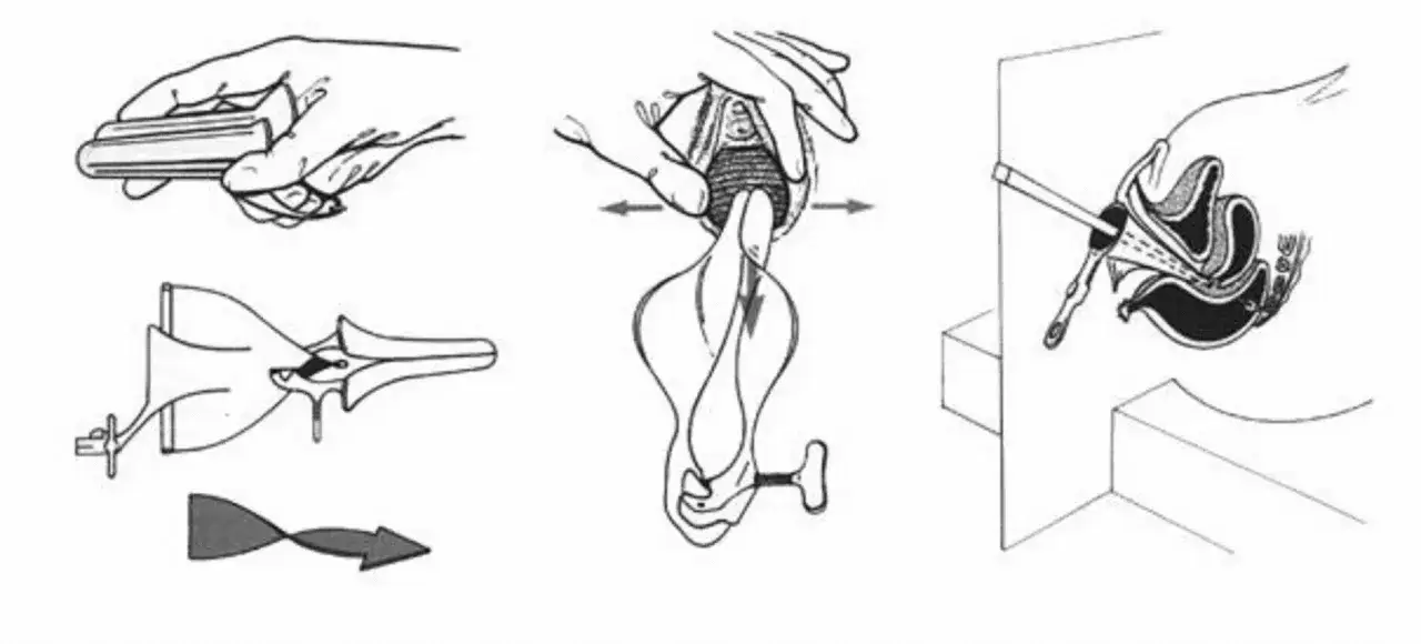 Illustration d'un examen gyn&eacute;cologique montrant l'utilisation d'un sp&eacute;culum pour visualiser le col de l'ut&eacute;rus et l'ut&eacute;rus.