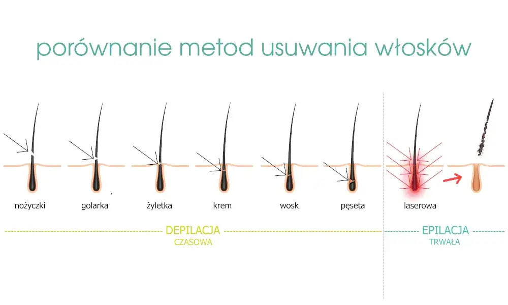 elektroepilacja vs depilacja laserowa porównanie