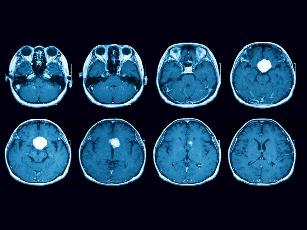 Sezioni di risonanza magnetica cerebrale che mostrano un tumore al cervello, evidenziato in bianco, in diverse aree del cervello.