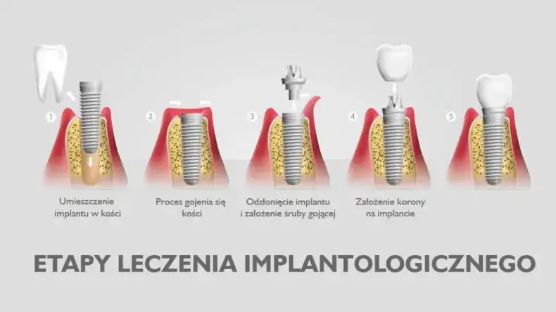 Proces wszczepienia implantu zębowego schemat