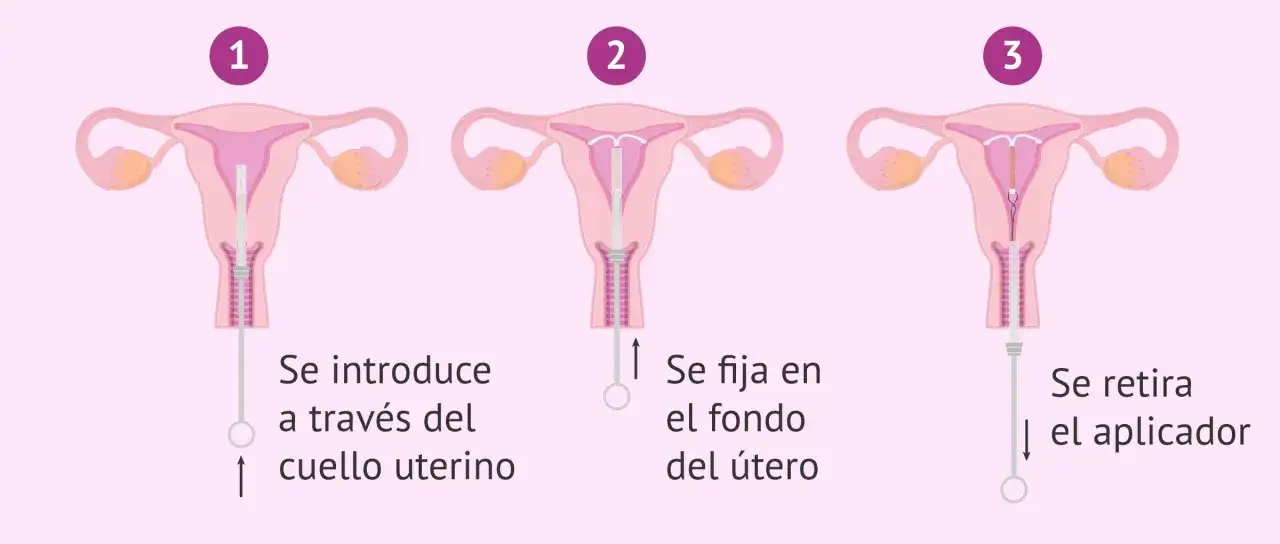 Ilustraci&oacute;n muestra la inserci&oacute;n de un DIU en el &uacute;tero. Aunque a veces duele ponerse el DIU, es un m&eacute;todo anticonceptivo eficaz.