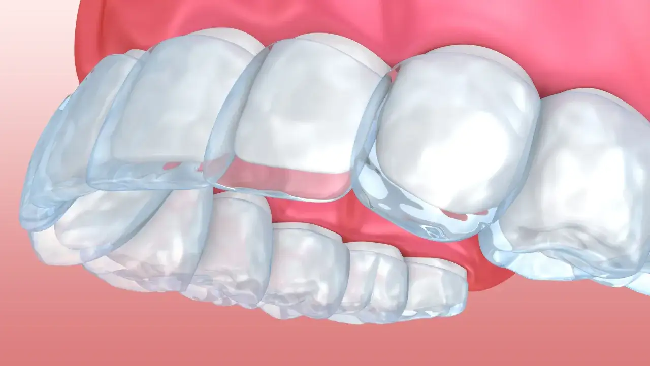 Dientes con alineadores transparentes. Aunque son discretos, a veces el proceso de moverlos con Invisalign duele.