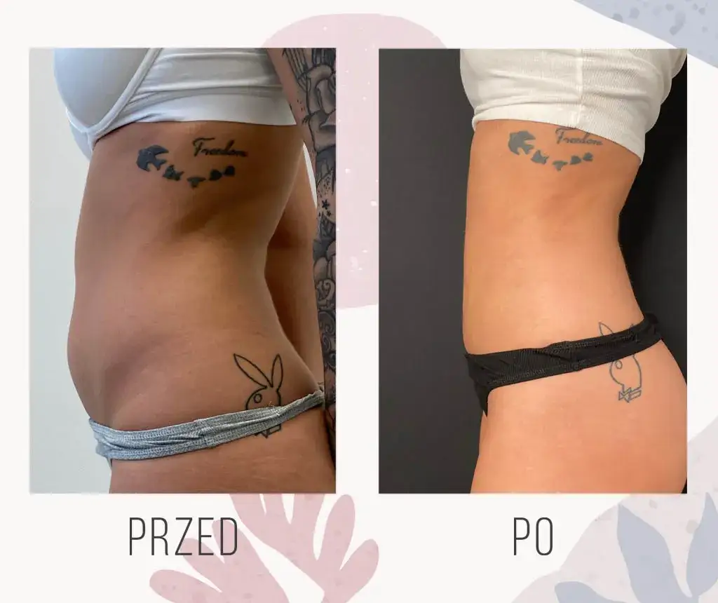 Liposukcja przed i po rekonwalescencja