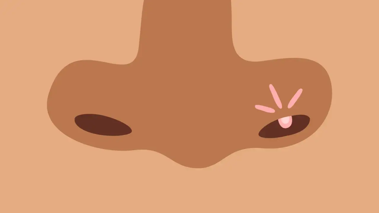 Un bouton dans le nez douloureux que faire ? Illustration d'un nez avec un bouton rouge et des rayons roses, symbolisant la douleur.