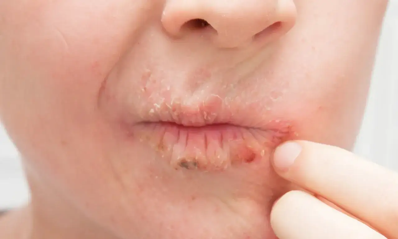 Trockene, rissige Lippen mit Schuppen und Rötungen, möglicherweise eine Spargelallergie. Ein Finger berührt die betroffene Stelle.