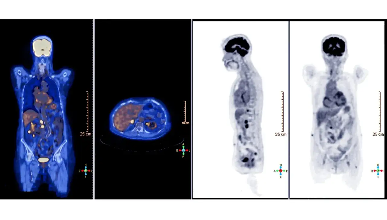 Immagini PET/CT mostrano quali tumori si vedono: aree di iperaccumulo nel fegato, addome e pelvi.