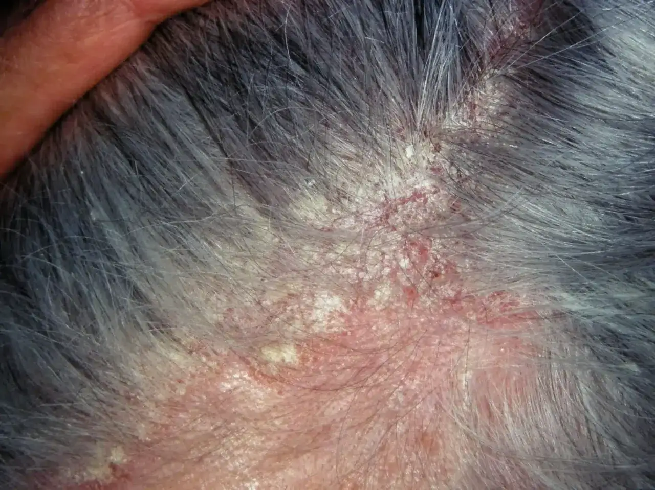 Primer plano de un cuero cabelludo con descamación, enrojecimiento e inflamación, cubierto por cabello gris.