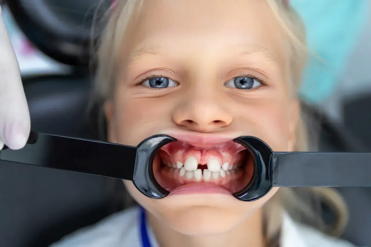 Uśmiechnięta dziewczynka z niebieskimi oczami, u której widoczna jest diastema u dzieci.