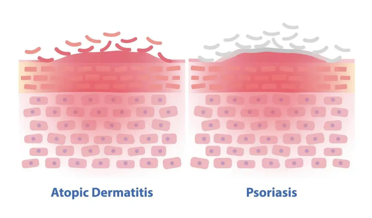 Illustration visar hudlager vid atopiskt eksem och psoriasis. Eksem kan vara ett tecken p&aring; obalans i kroppen.
