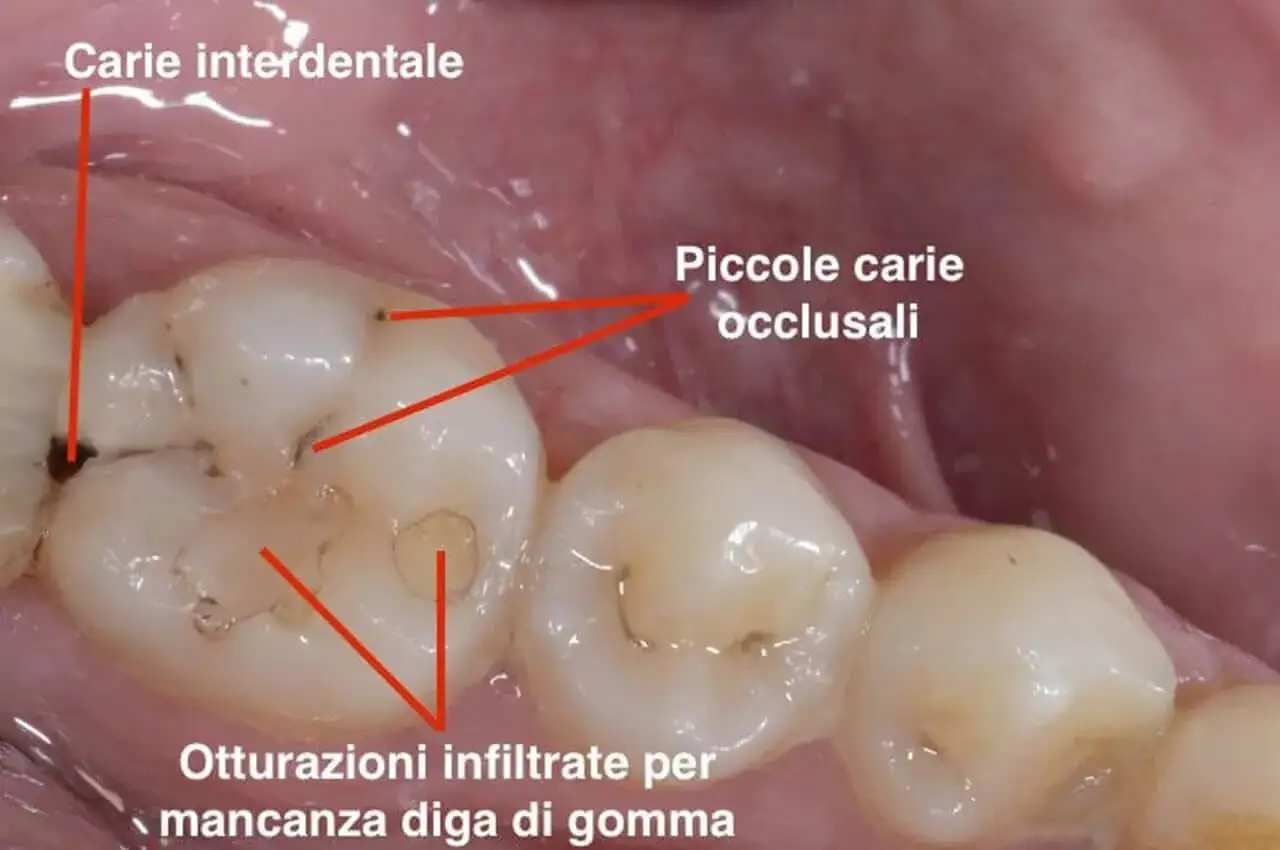 Denti con carie interdentale, piccole carie occlusali e otturazioni infiltrate. I sintomi della carie possono variare.