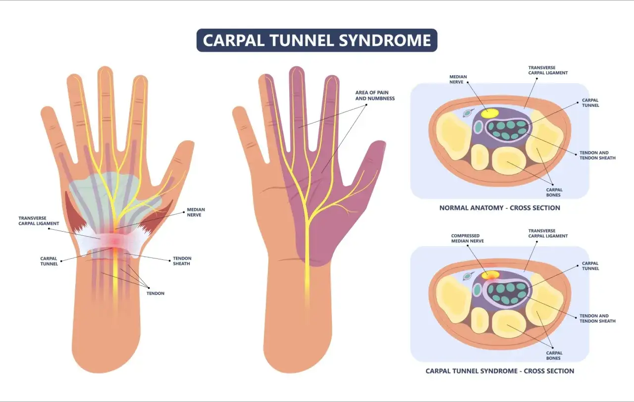 Illustration du syndrome du canal carpien : anatomie normale et affectée du poignet, montrant la compression du nerf médian.