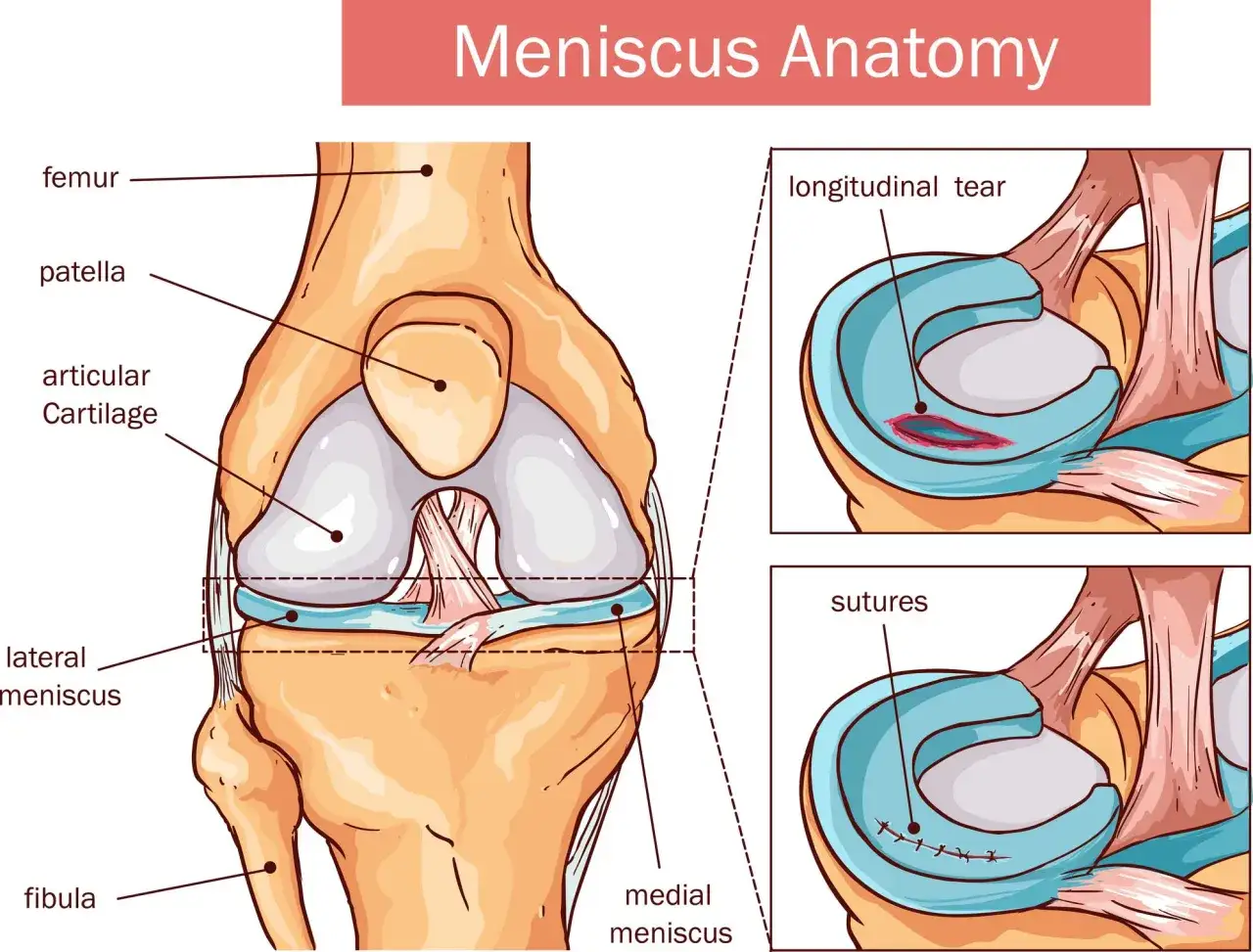 Anatomia kolana: uszkodzenie łąkotki bocznej z podłużnym pęknięciem i późniejsze zszycie.