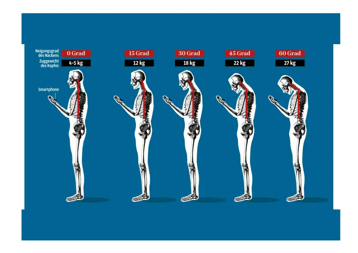 Haltungsschäden durch Smartphone-Nutzung: Der buckel im Nacken Ursache ist die zunehmende Neigung des Kopfes, die das Zuggewicht auf die Wirbelsäule erhöht.