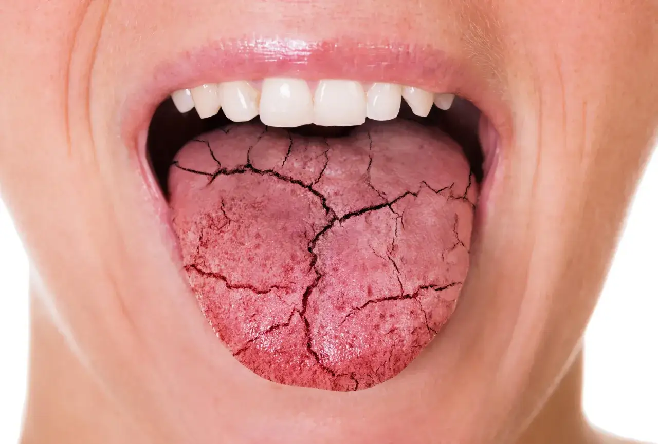 Lengua agrietada, s&iacute;ntoma de diabetes y riesgo de caries.