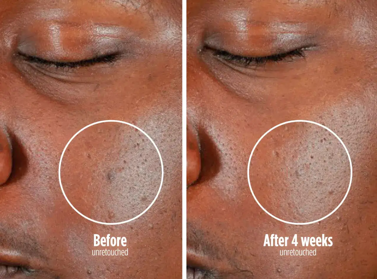 Comparaison avant/après d'un masque LED visage : la peau semble plus lisse et les pores moins visibles après 4 semaines.