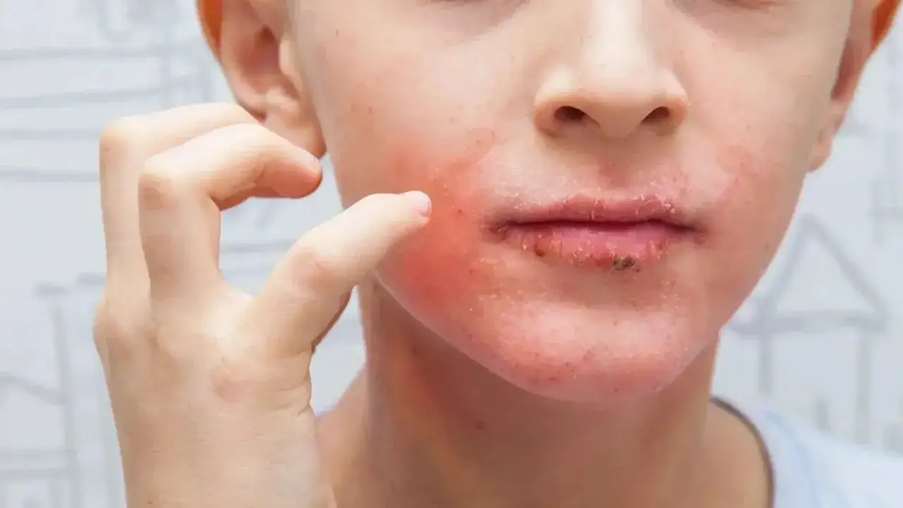Visage d'enfant irrit&eacute;, rougeurs et peau s&egrave;che autour des l&egrave;vres, possible effet secondaire de l'huile de tamanu.