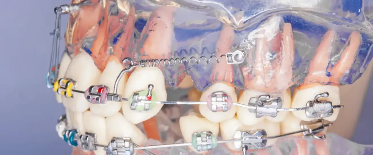 Model szczęki z kolorowymi zamkami i drutami, widoczny mini implant ortodontyczny jako element stabilizujący.