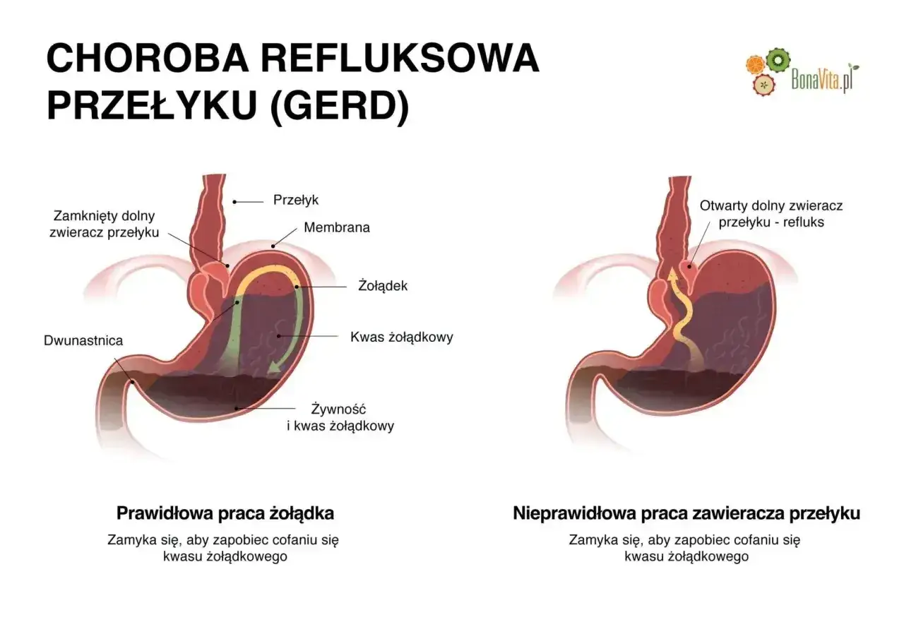 Ilustracja pokazuje prawidłowe i nieprawidłowe działanie żołądka. Ciągła zgaga czy to rak? GERD to refluks żołądkowo-przełykowy.