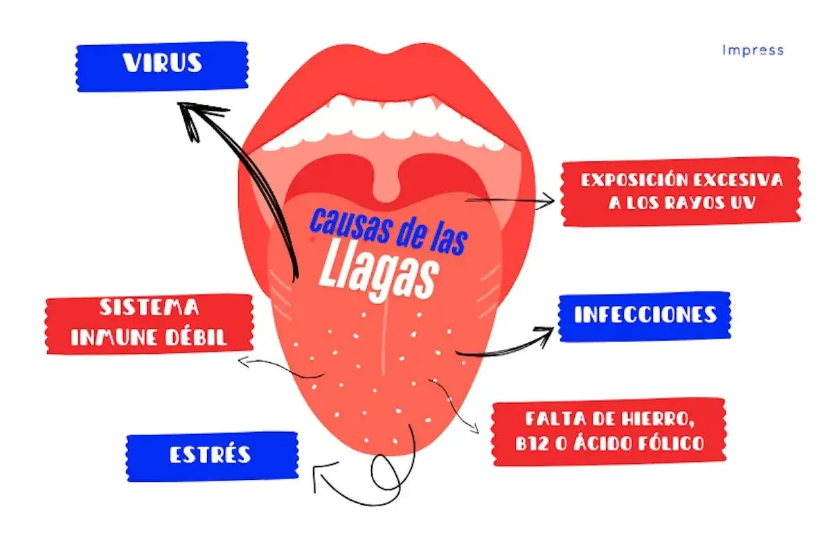 Ilustración de boca abierta mostrando causas de las llagas: virus, sistema inmune débil, estrés, exposición UV, infecciones, falta de hierro/B12/ácido fólico. Las llagas son contagiosas.